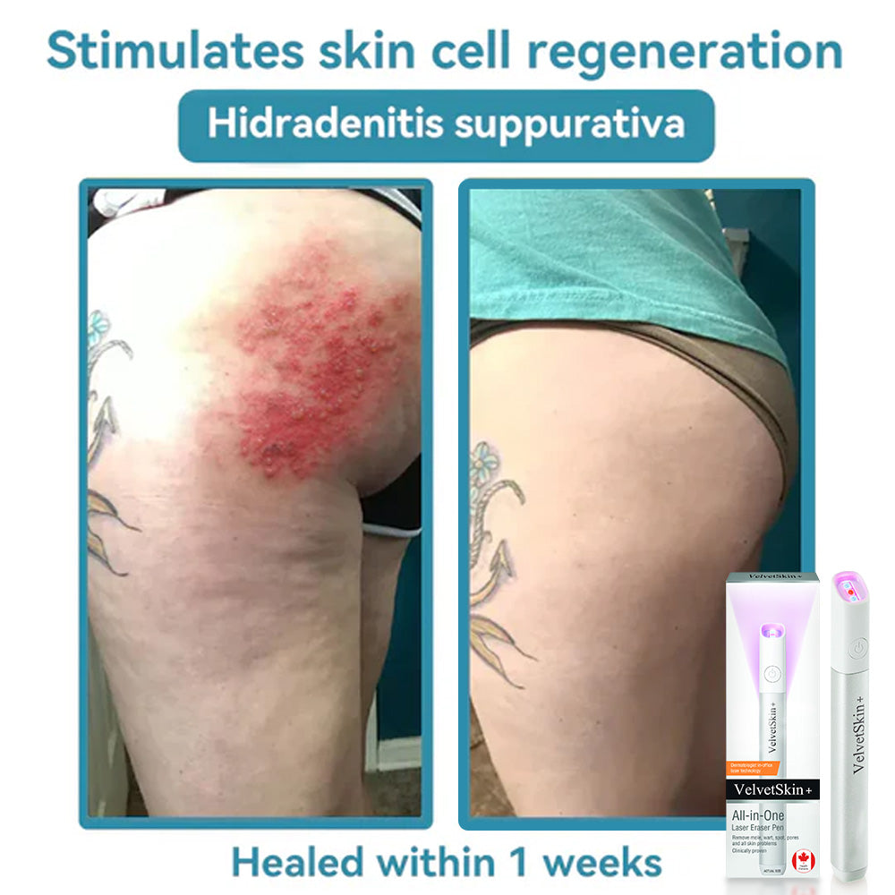 ☂DedMuller® VelvetSkin+Series ⚔️All-in-One Laser Eraser Pen🖊️ (🔬Powered by CO₂ laser technology – effectively removes moles, warts, skin tags, pigmentation spots, and other skin imperfections)